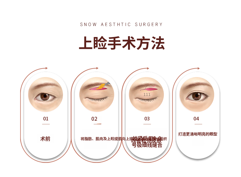 中年眼部整形 上睑眼睑手术 眉毛提升