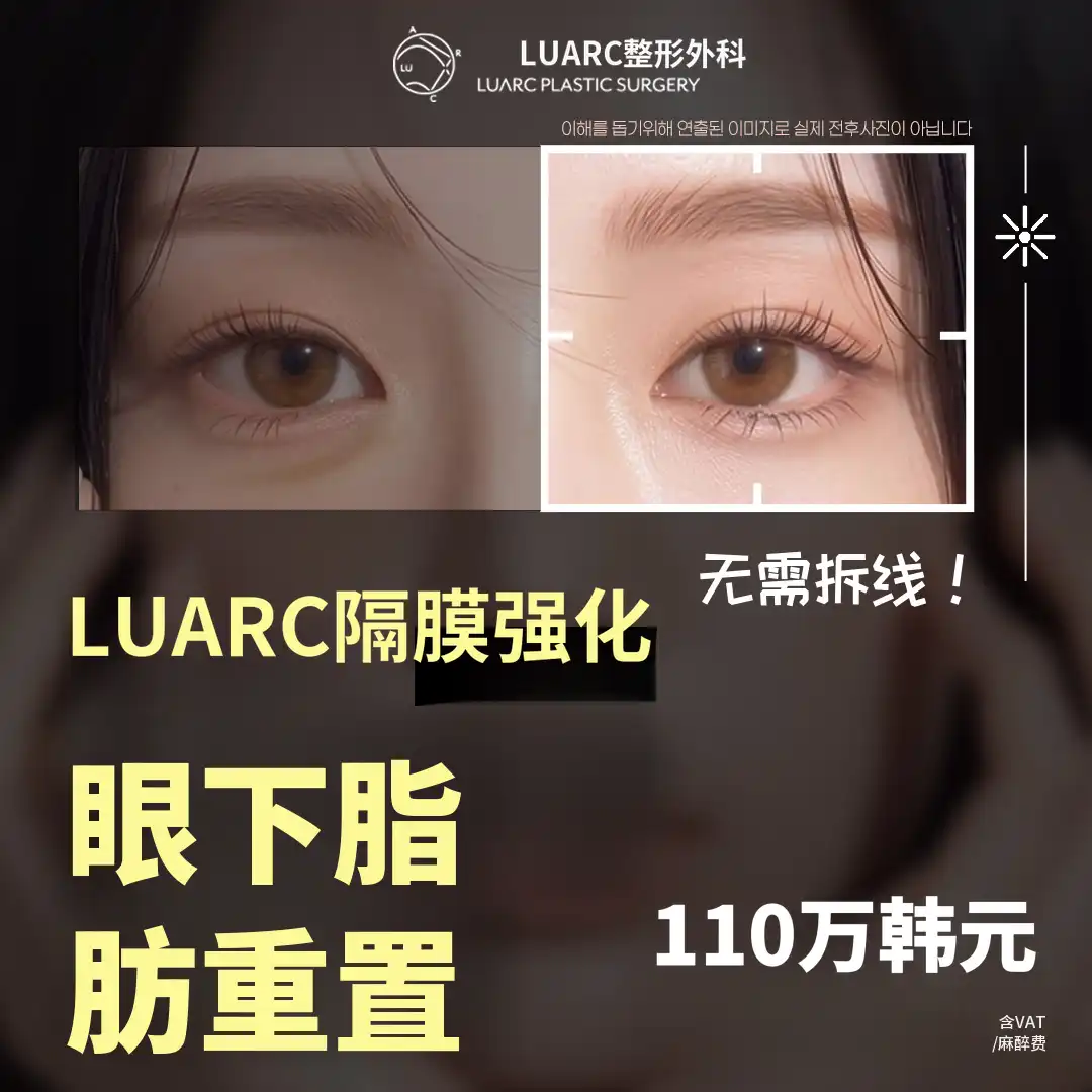 鲁阿克膜增强下眼睑脂肪再分配