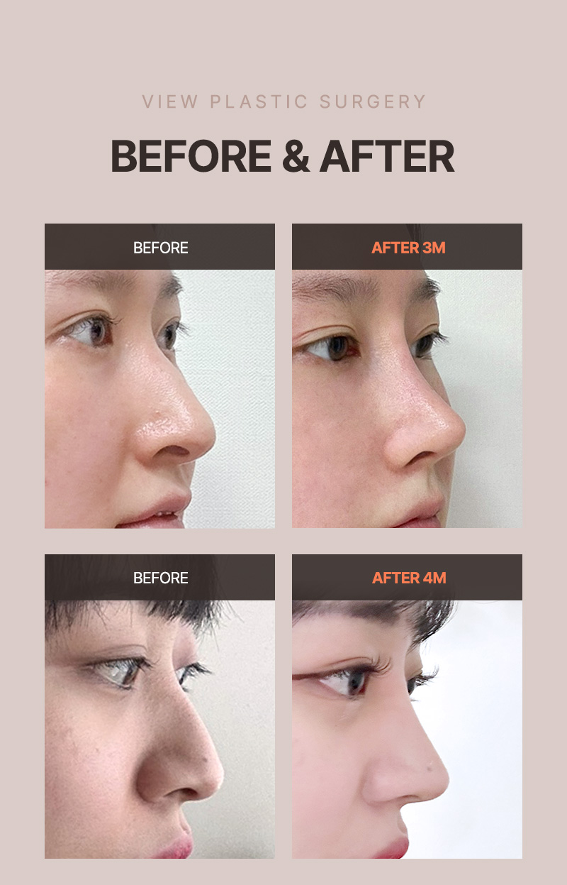 ❤️View❤️Functional Nose Surgery