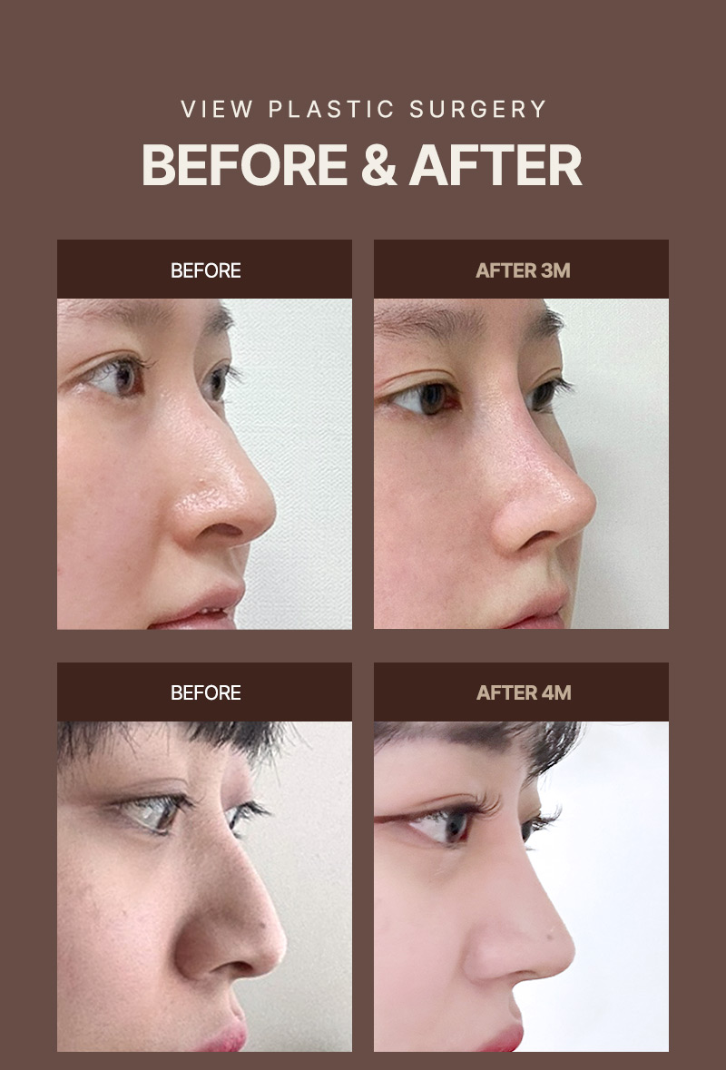 ❤️View❤️Functional Rhinoplasty