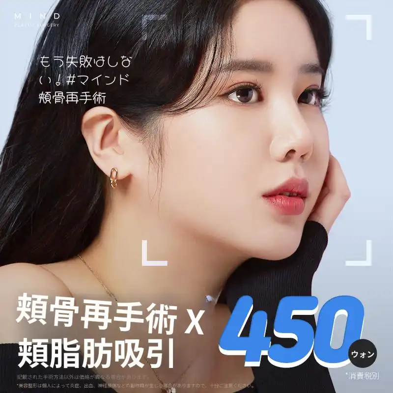 [マインド] 頬骨再手術
