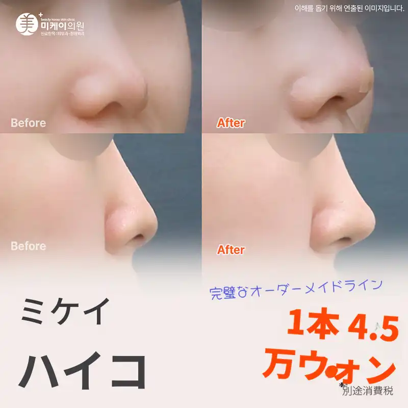 ミケイ自信を持った鼻梁ミントリフティング_ハイコ