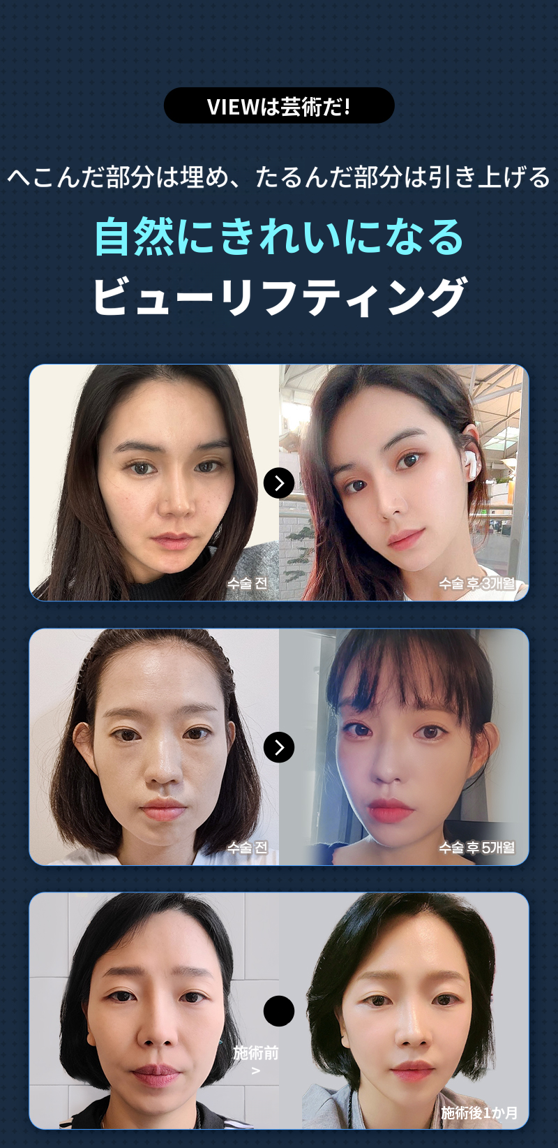 ❤️ビュー❤️ シリフトニング