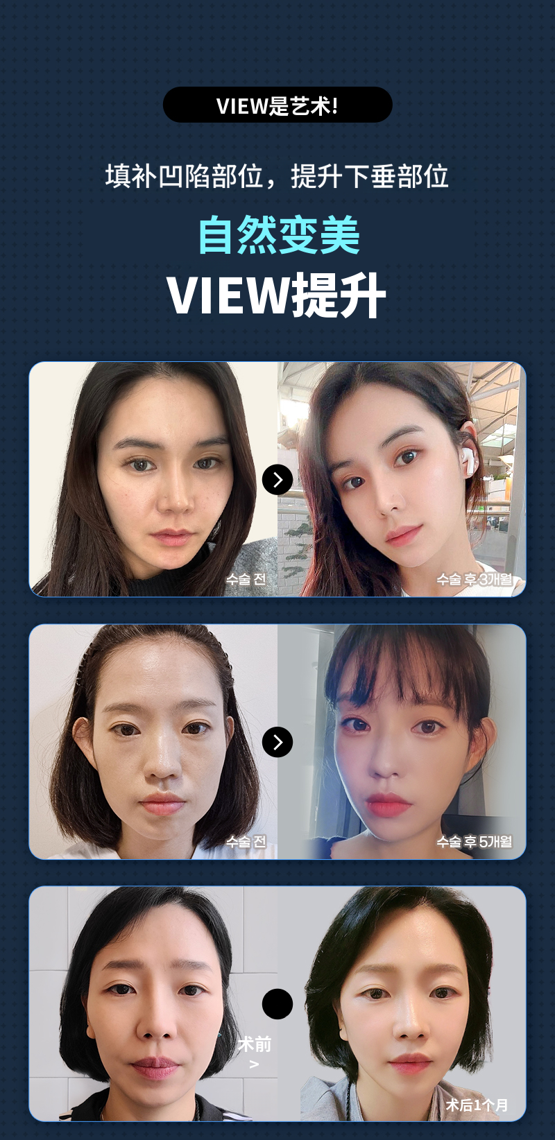 ❤️视图❤️ 脸部提升