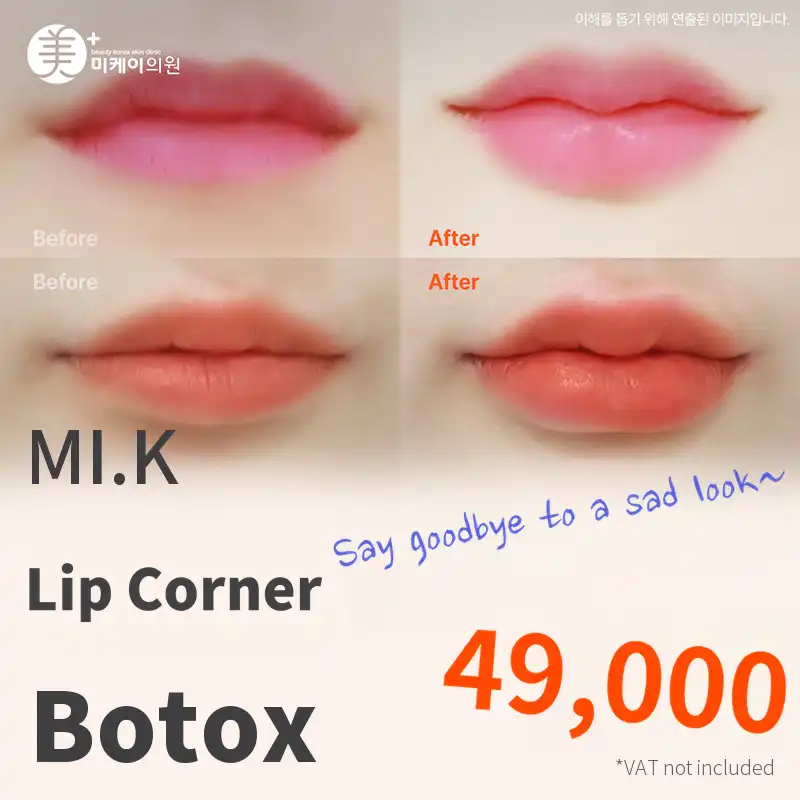 Mikey Lip Corner Botox