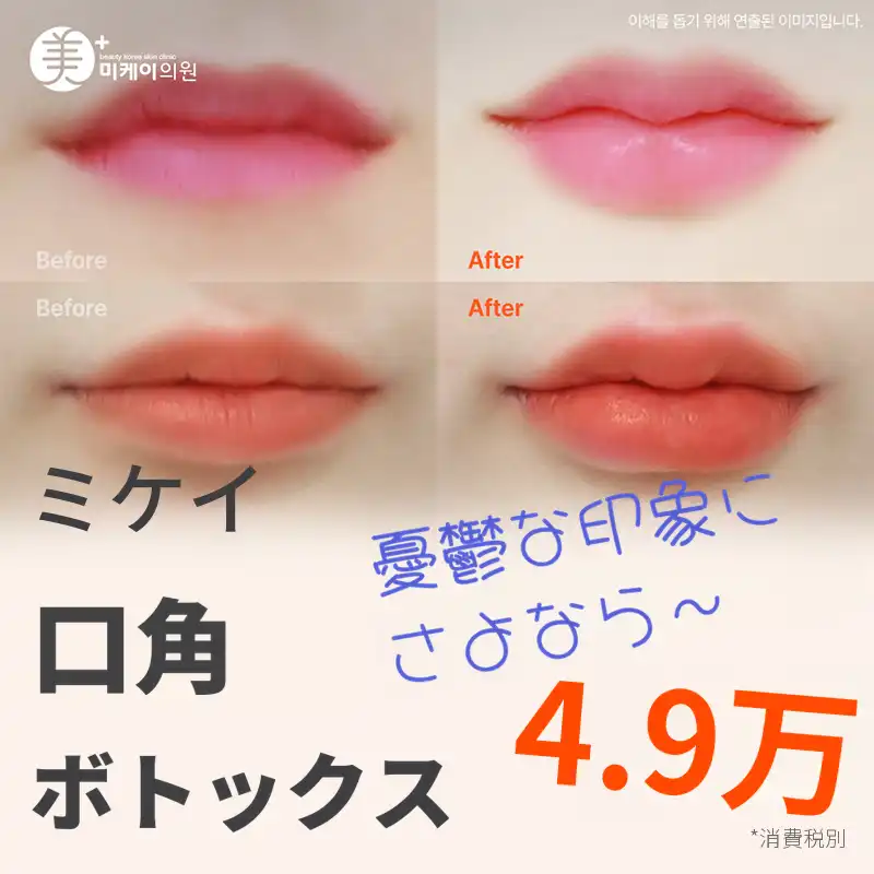 ミケイ口角ボトックス
