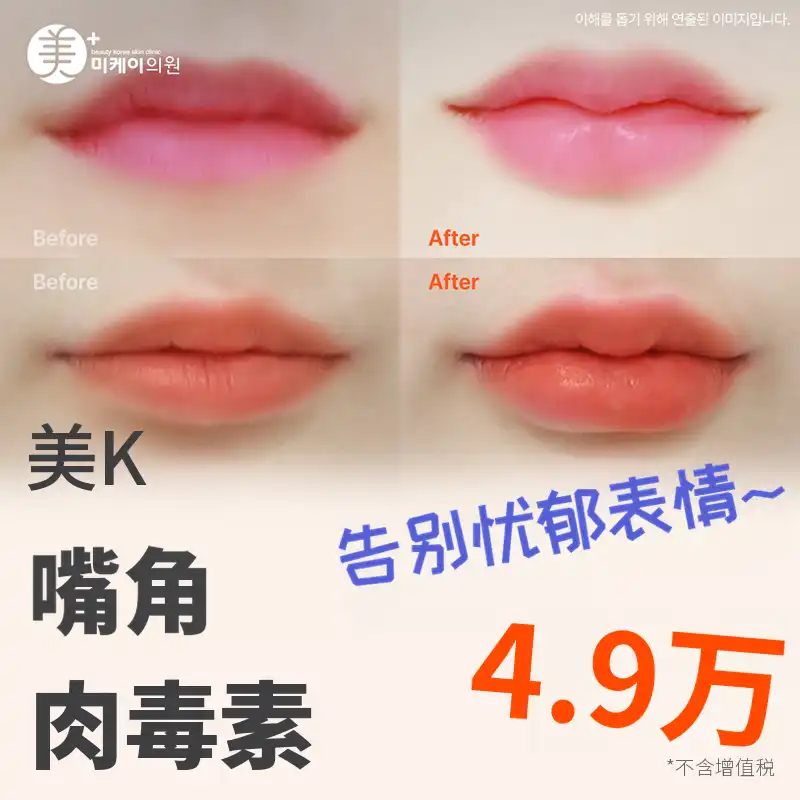 米凯上唇微笑瘦脸肉毒素