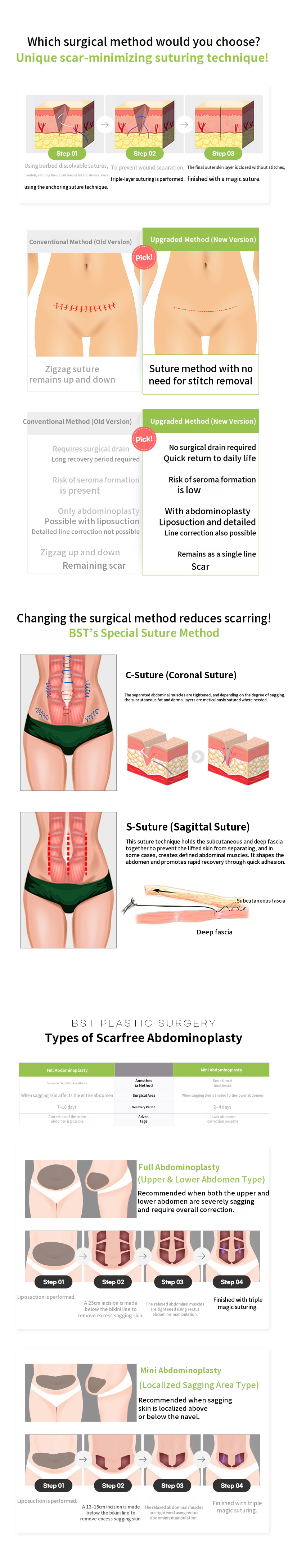 ❤️Scarf Mini Abdominoplasty❤️