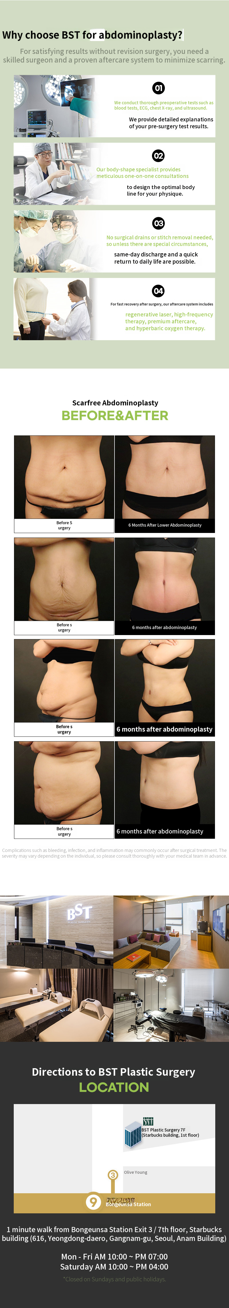 ❤️Scarf Mini Abdominoplasty❤️