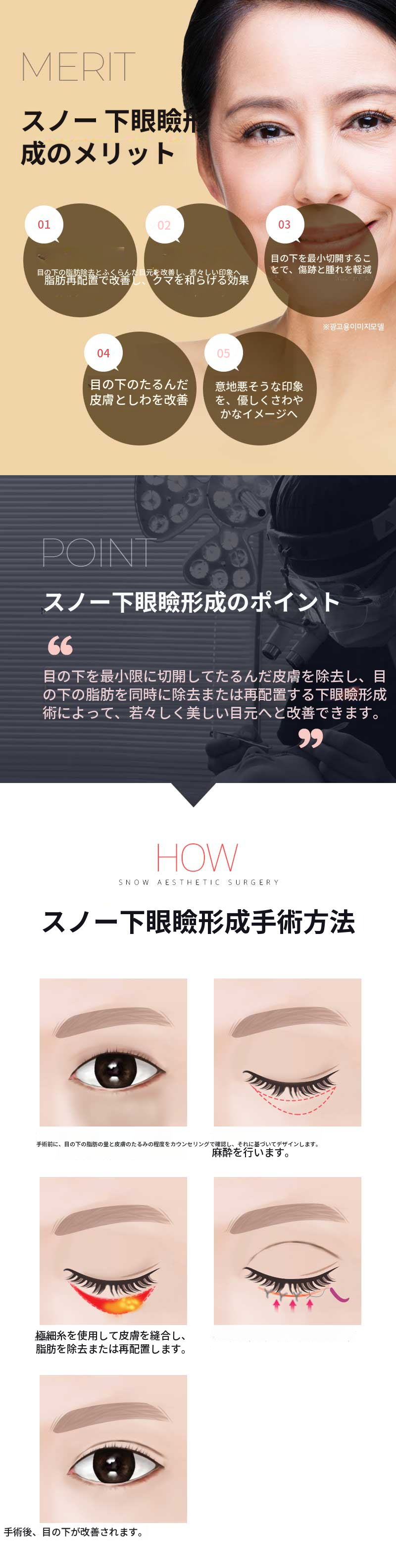 中年の目の整形　下まぶたの手術