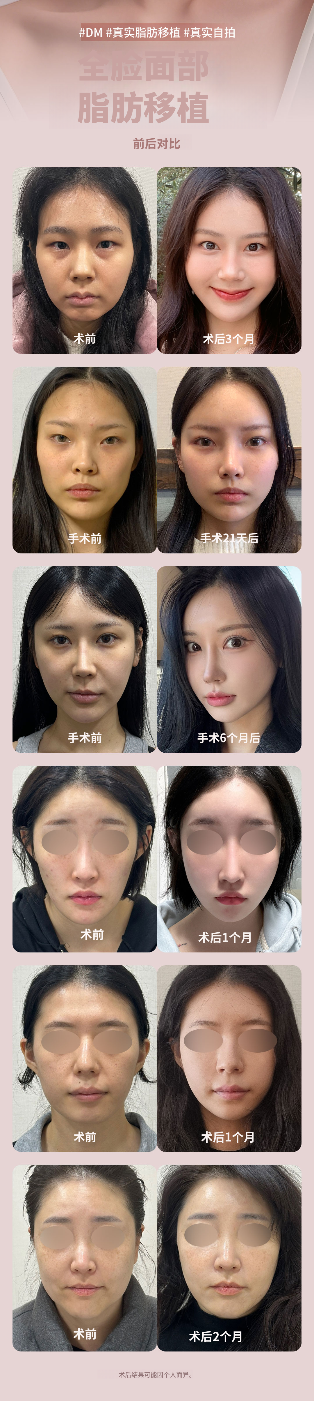 ★全脸脂肪移植★