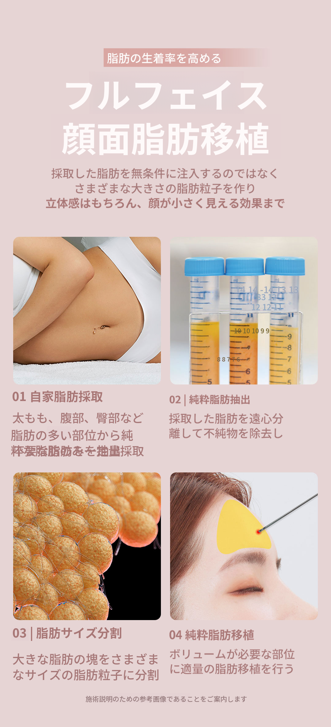 ★フルフェイス顔脂肪移植★