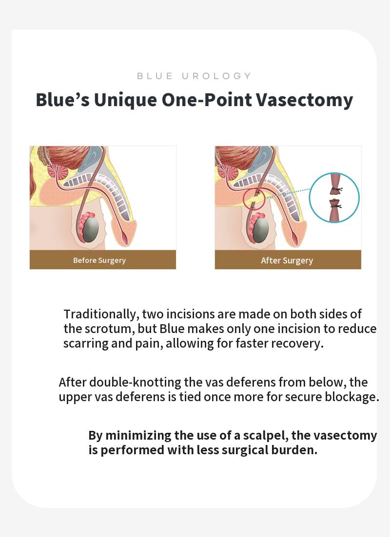 Yeongdeungpo) Vasectomy surgery EVENT