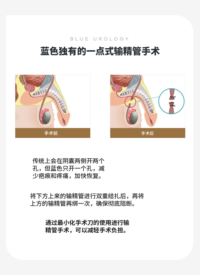 永登浦) 无痛输精管手术活动