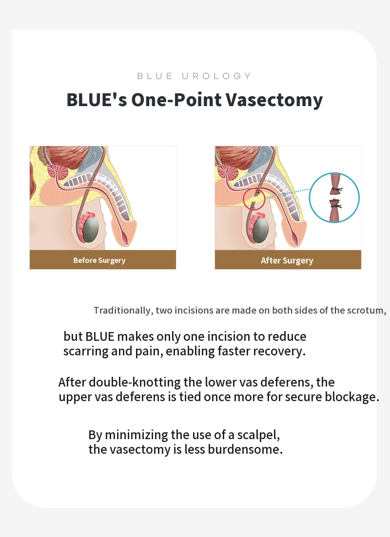 Hanam Misa) Vasectomy surgery EVENT!