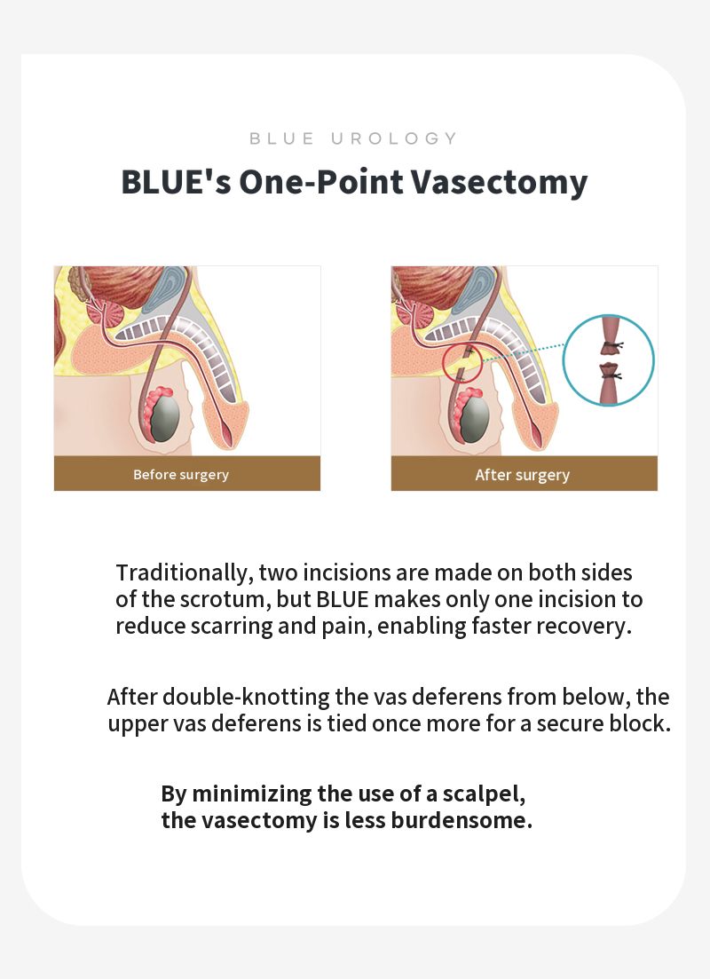 Pangyo) Vasectomy surgery EVENT