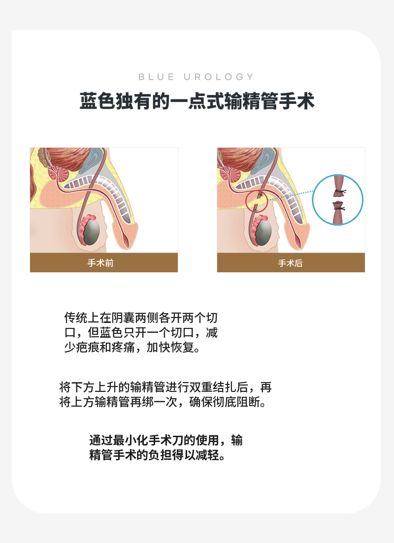 板桥) 无痛输精管手术活动