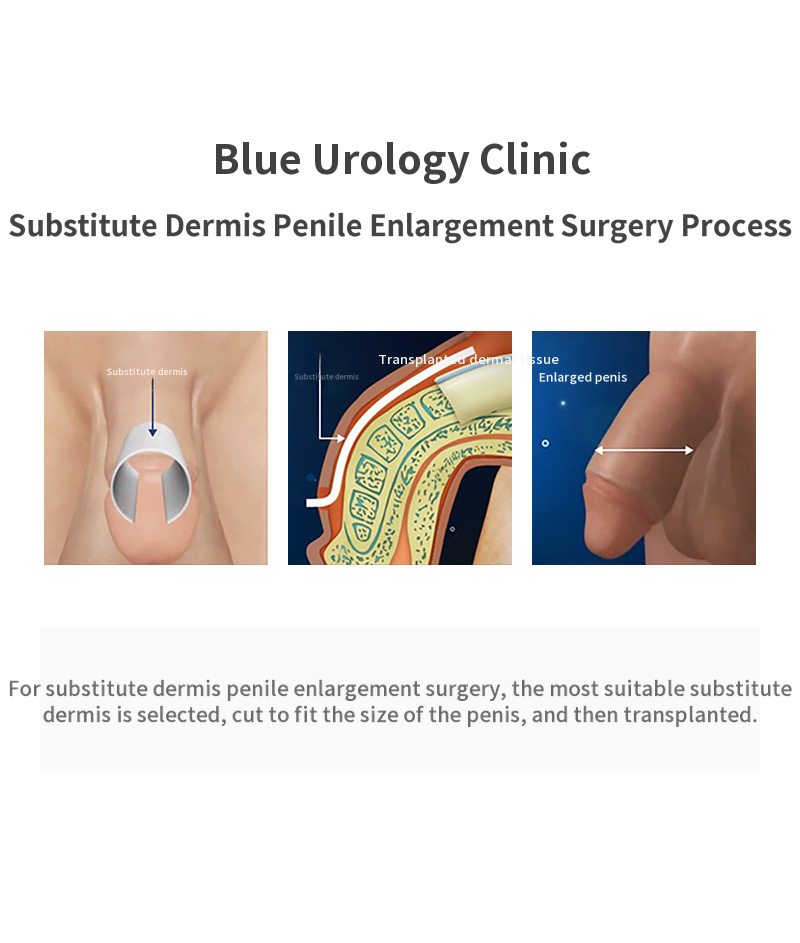 Yeongdeungpo) Alternative dermis expansion surgery EVENT