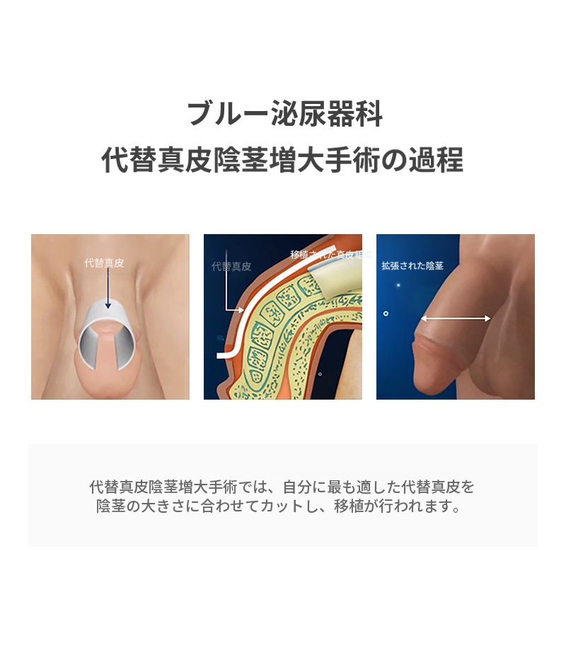 永登浦) 代替真皮拡大手術 EVENT