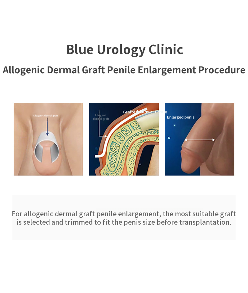 Hanam Misa) Alternative dermis expansion surgery EVENT