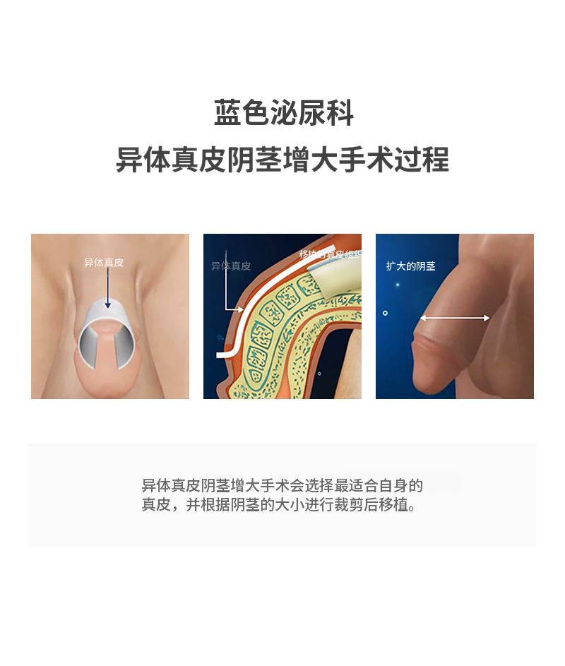 汉南美莎) 替代真皮扩展手术活动