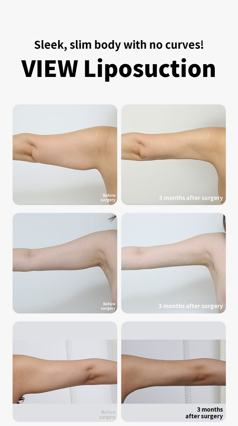 ❤️View❤️Large Capacity Liposuction