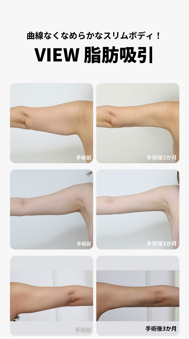 ❤️ビュー❤️大容量脂肪吸引