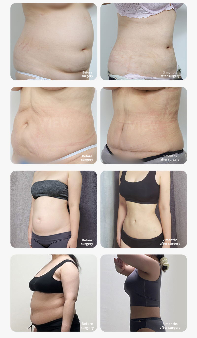 ❤️View❤️Large Capacity Liposuction