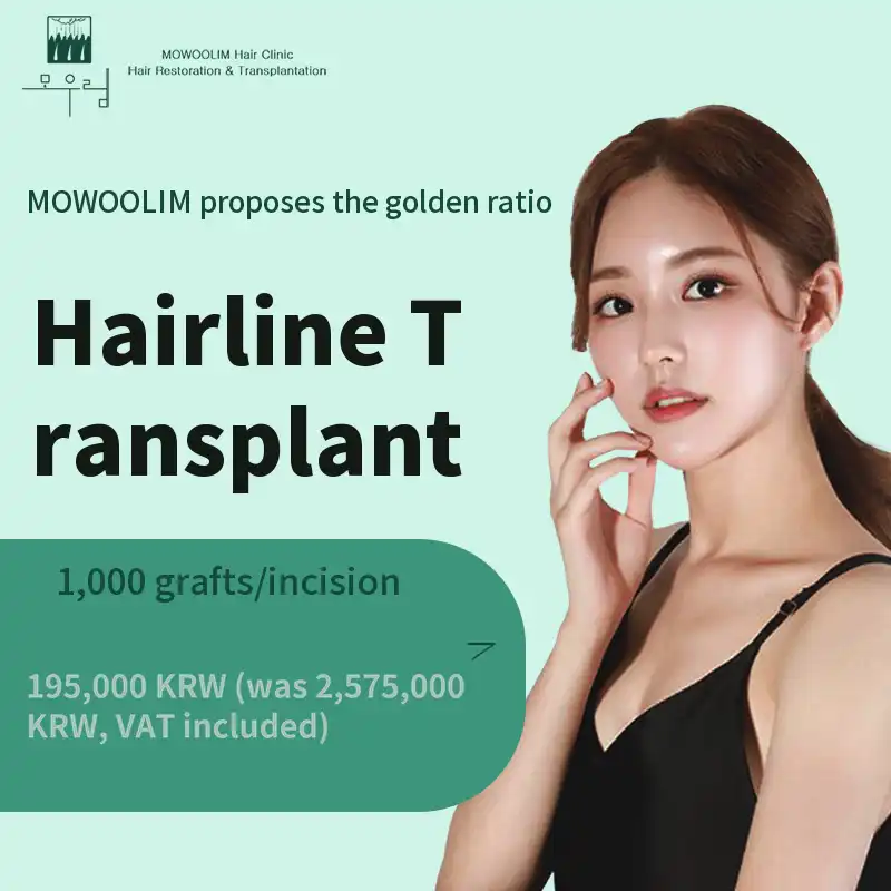 Hairline transplant 1000 hairs