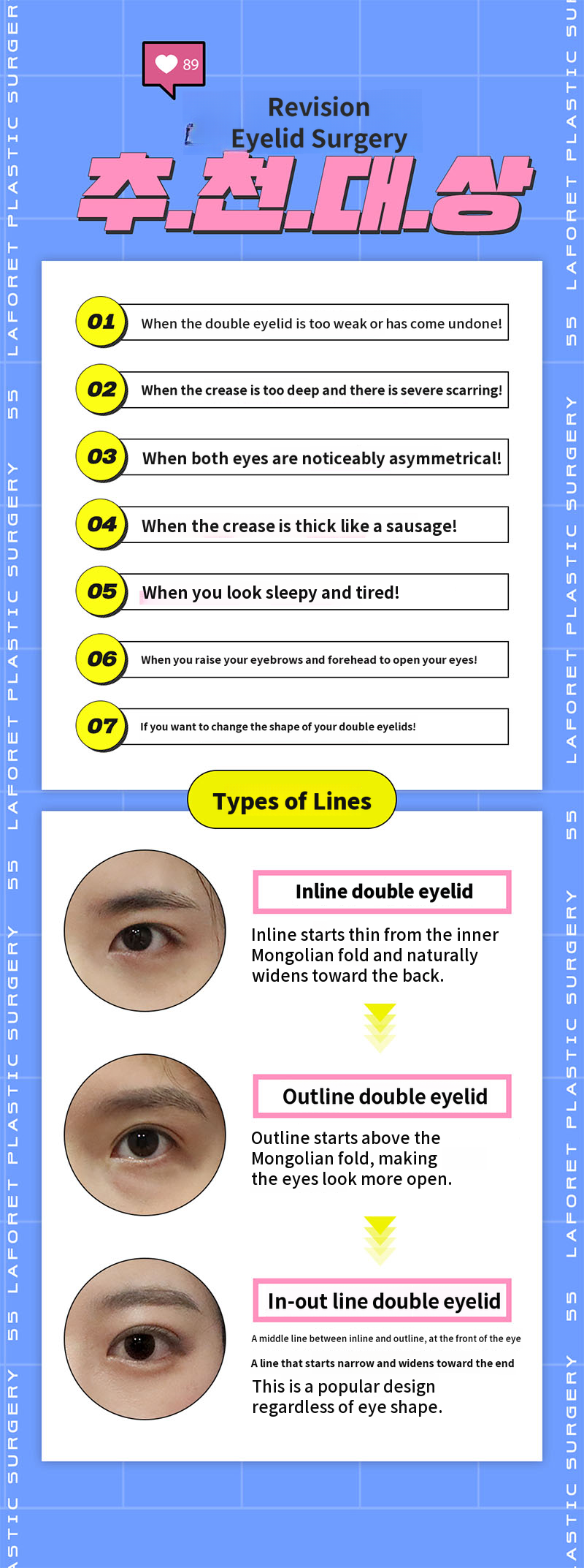 Eye re-surgery
