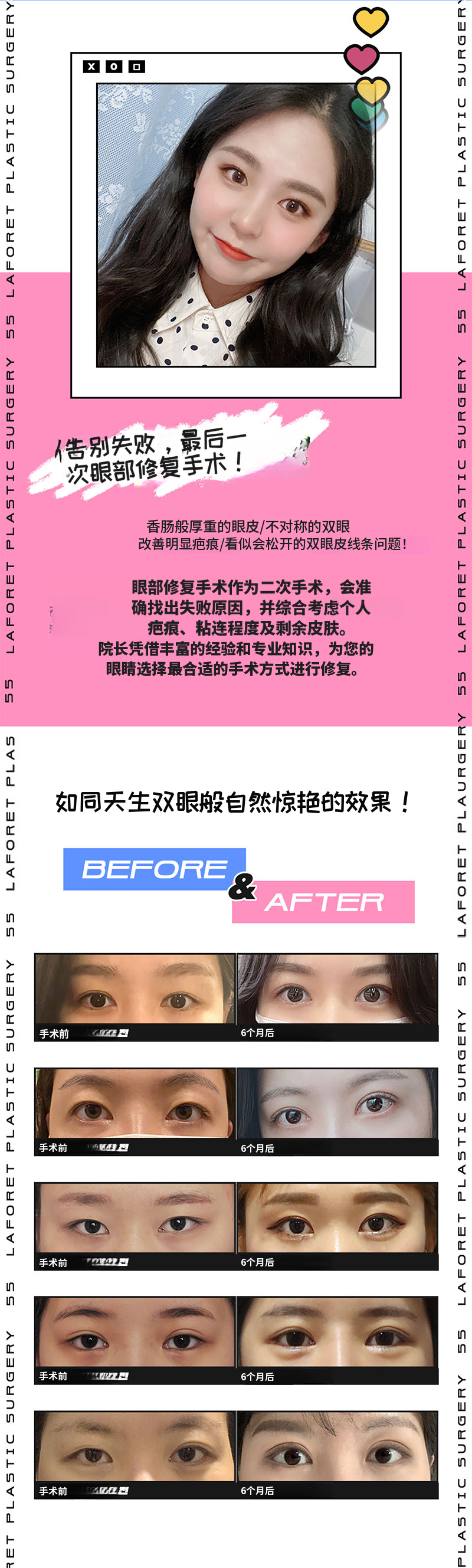 眼部再手术