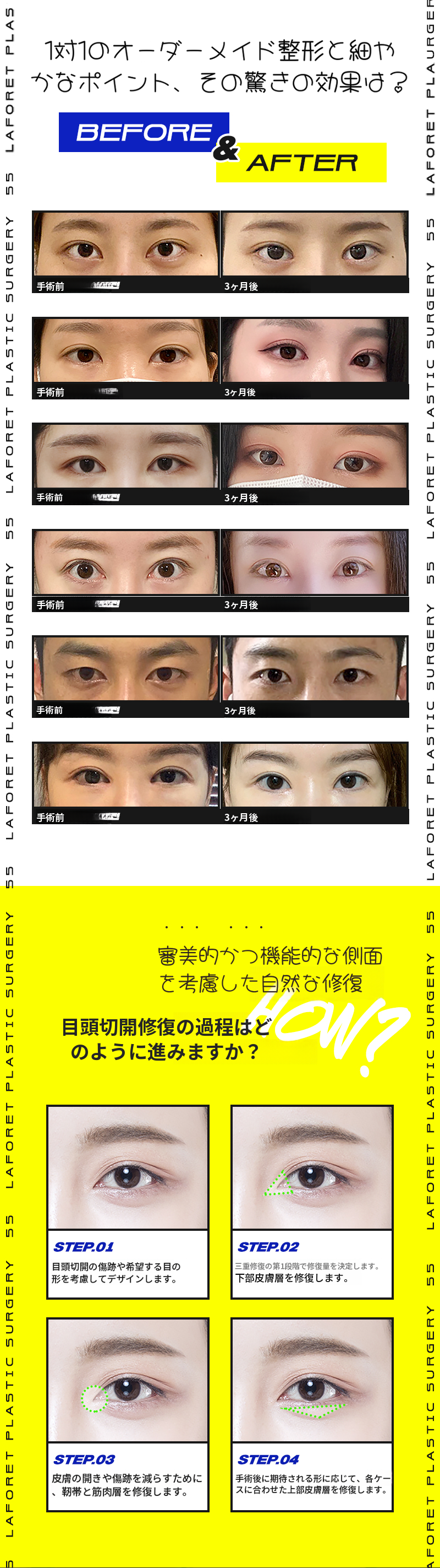 1mmの差、前切開復元