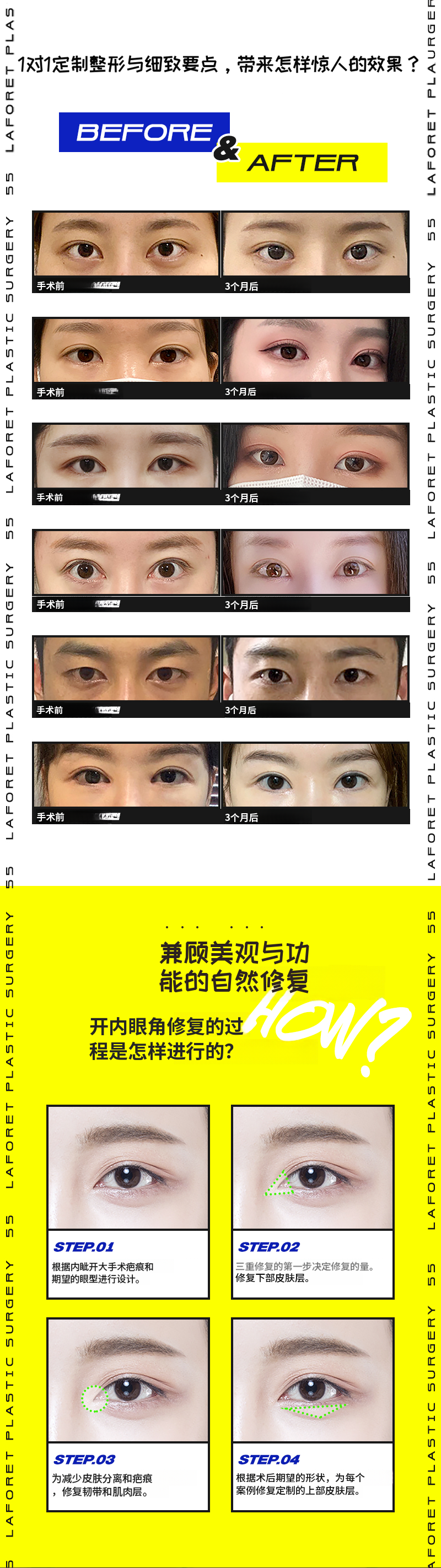 1mm的差距，前开眼角修复