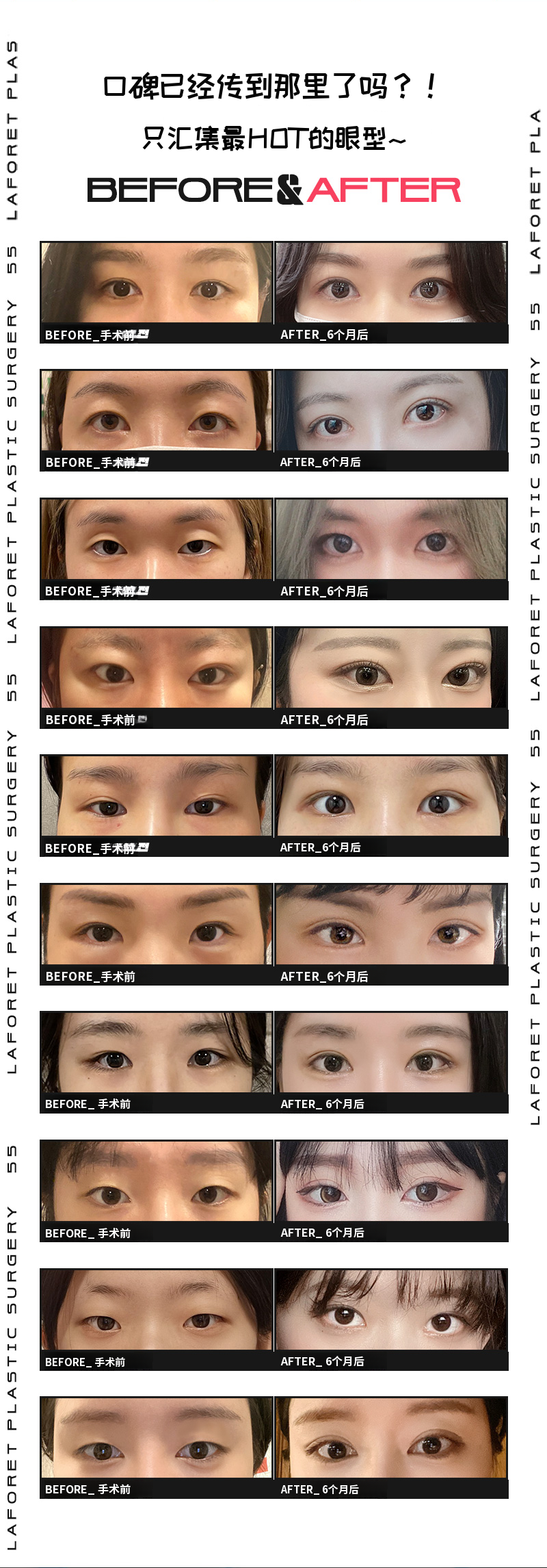 自然线条!清纯双眼皮