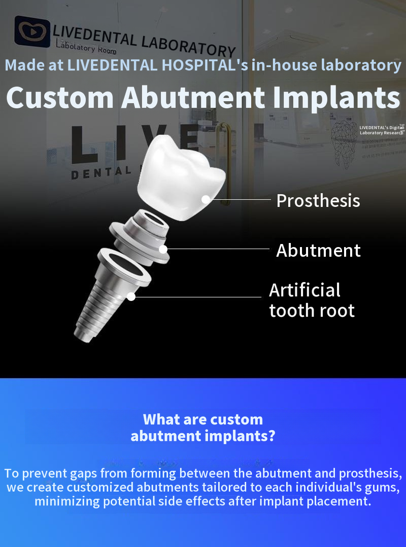Full-Mouth Dental Implants Including Simple Bone Grafting with Genuine Domestic Implants