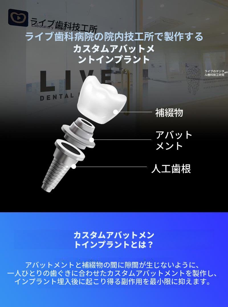 国産正規品・簡単な骨移植込みの全顎インプラント