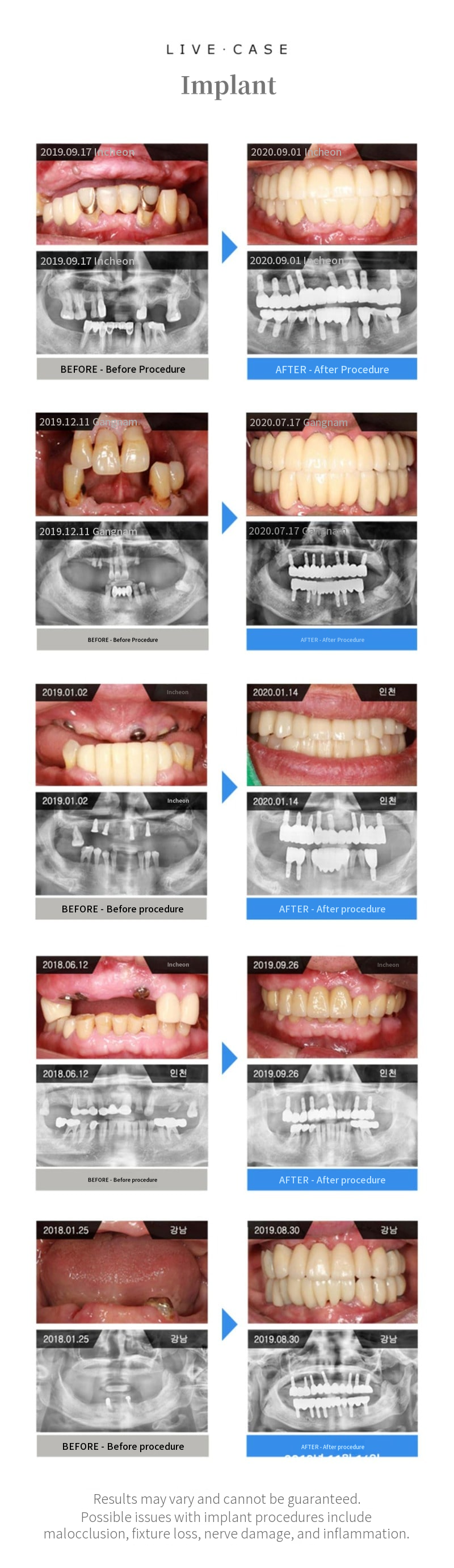 Domestic genuine all-inclusive implant with simple bone grafting