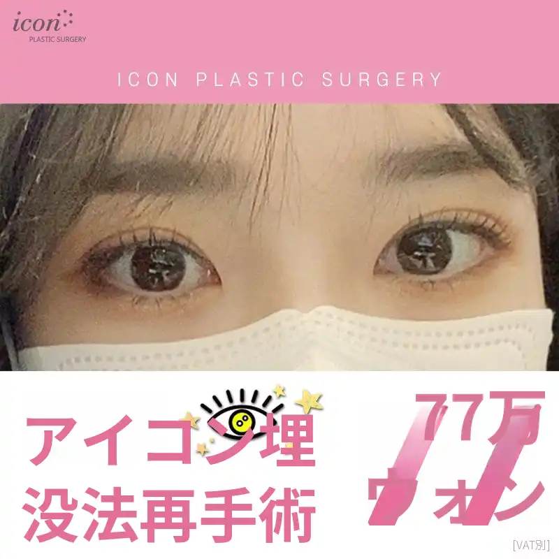 アイコン埋没再手術