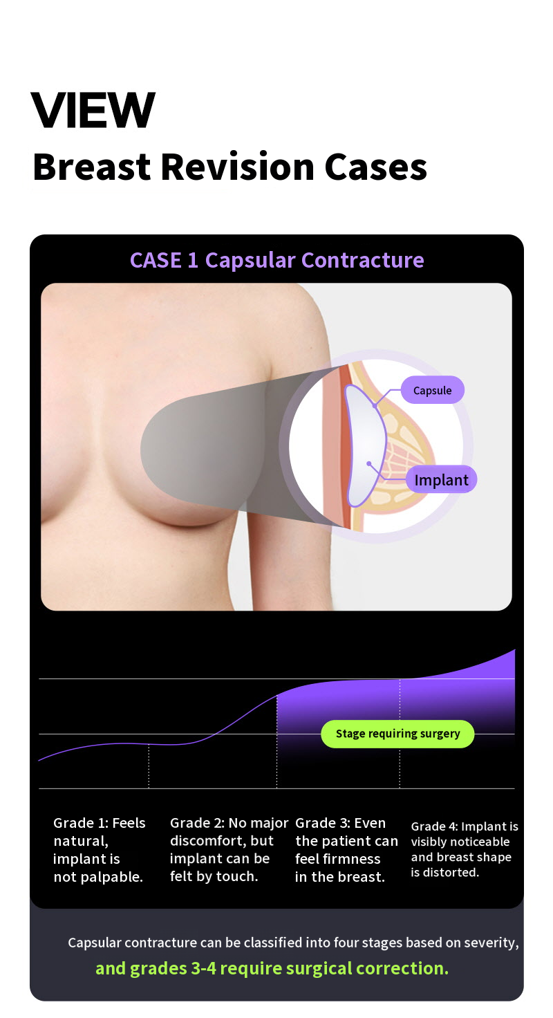 ❤View❤Motiva Breast Revision Surgery