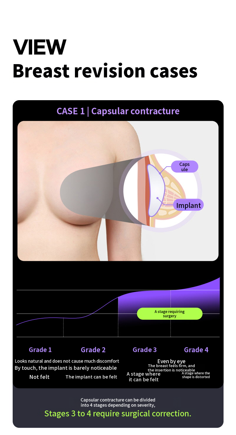❤View❤Motiva Breast Revision Surgery