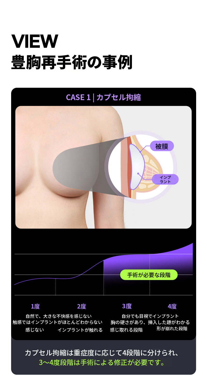 ❤ビュー❤モティバ 胸再手術
