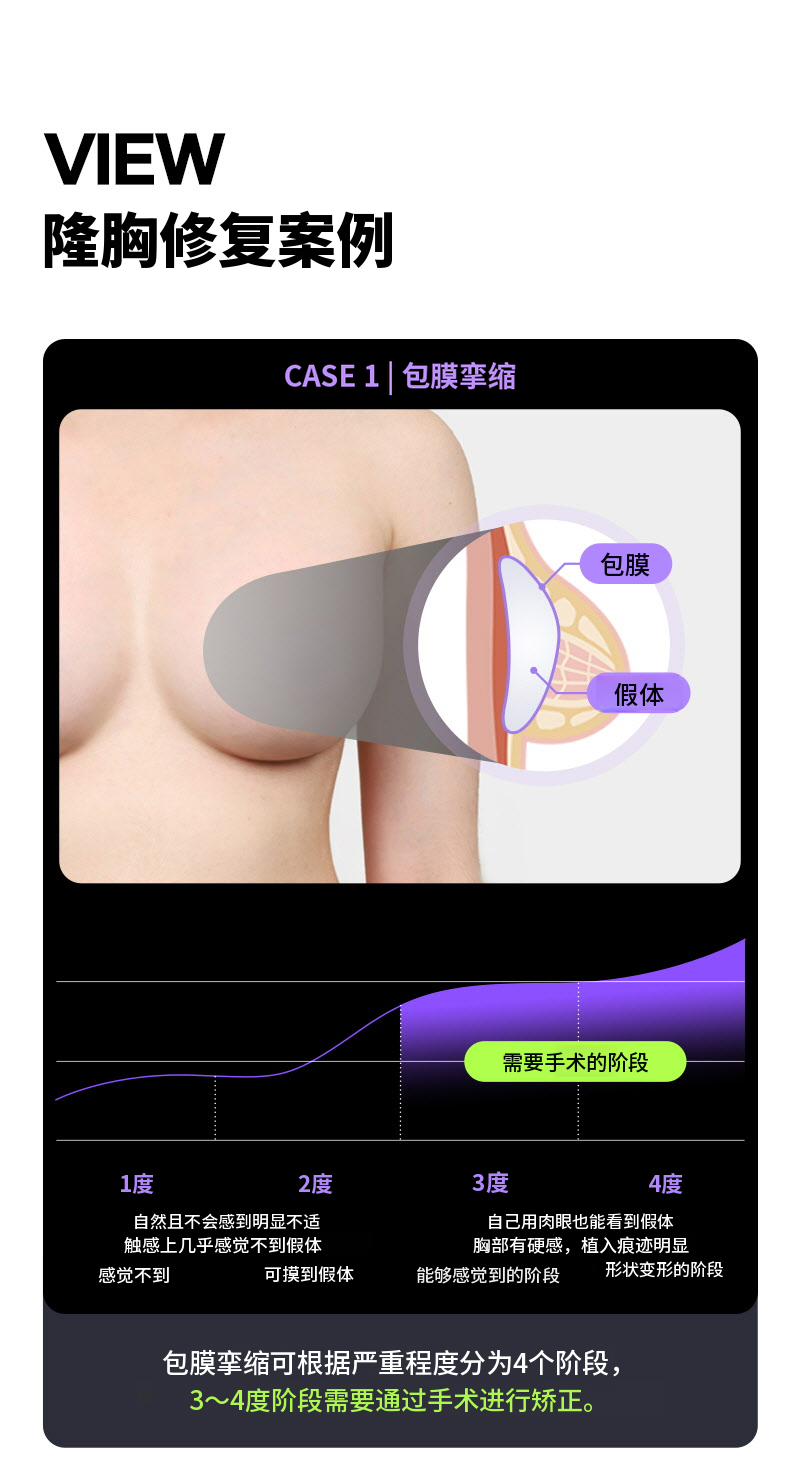 ❤视图❤Motiva胸部再手术
