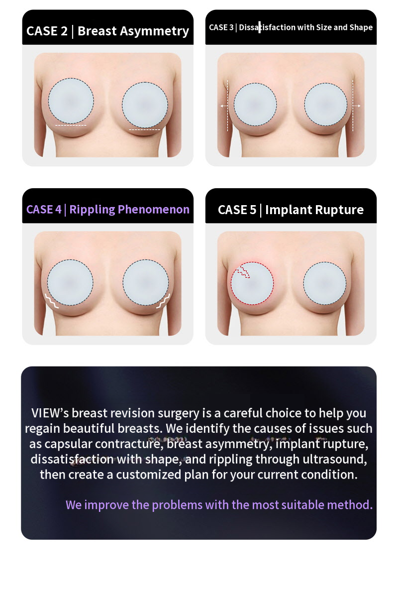 ❤View❤Motiva Breast Revision Surgery