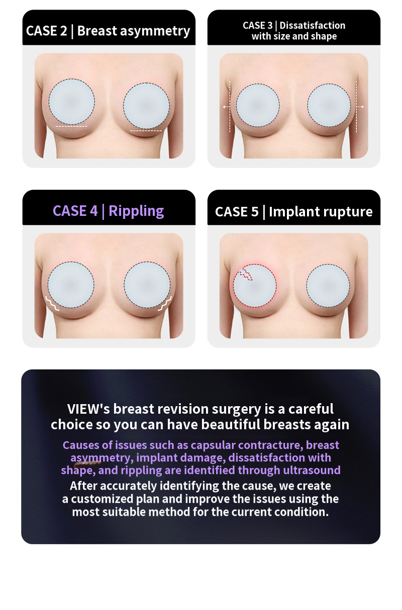 ❤View❤Motiva Breast Revision Surgery