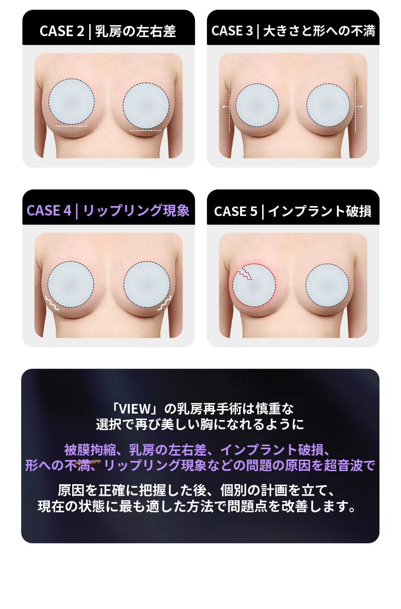 ❤ビュー❤モティバ 胸再手術