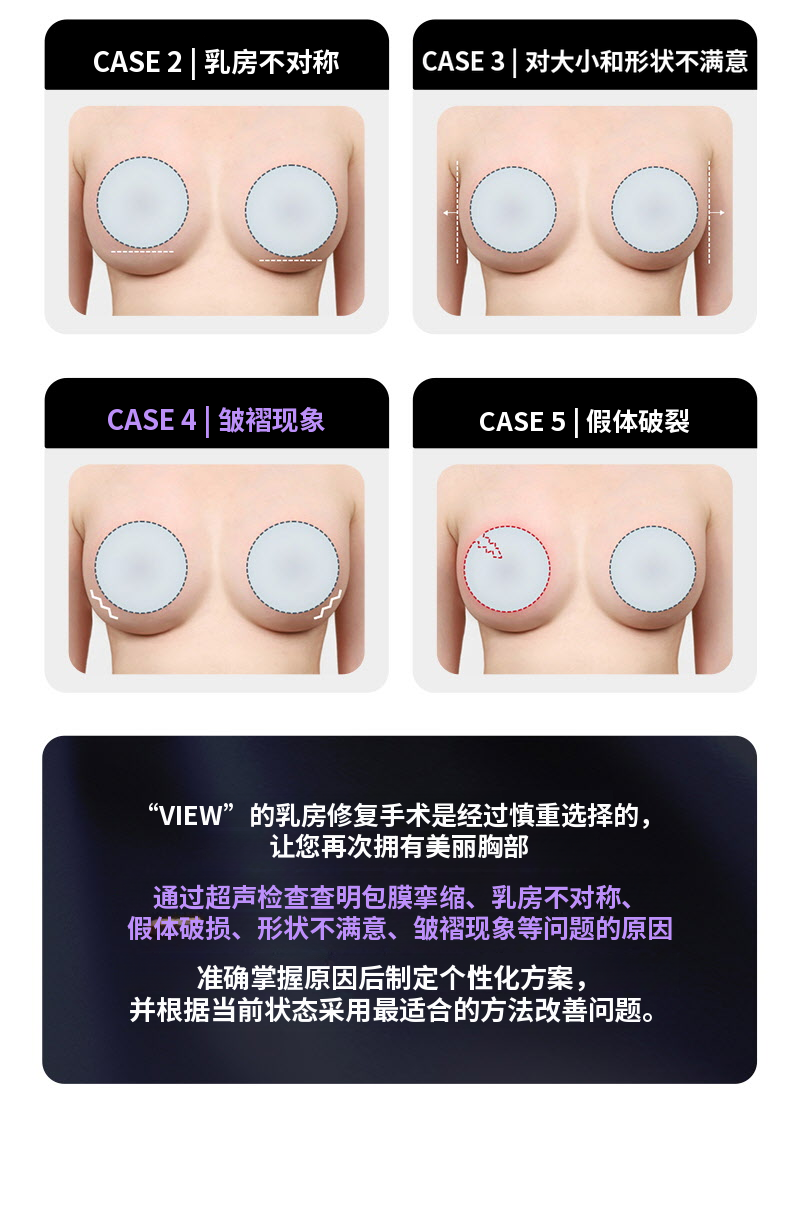 ❤视图❤Motiva胸部再手术