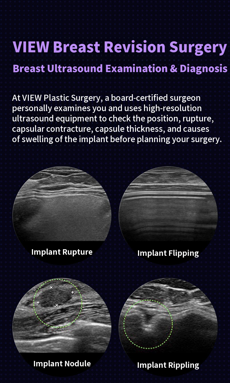 ❤View❤Motiva Breast Revision Surgery
