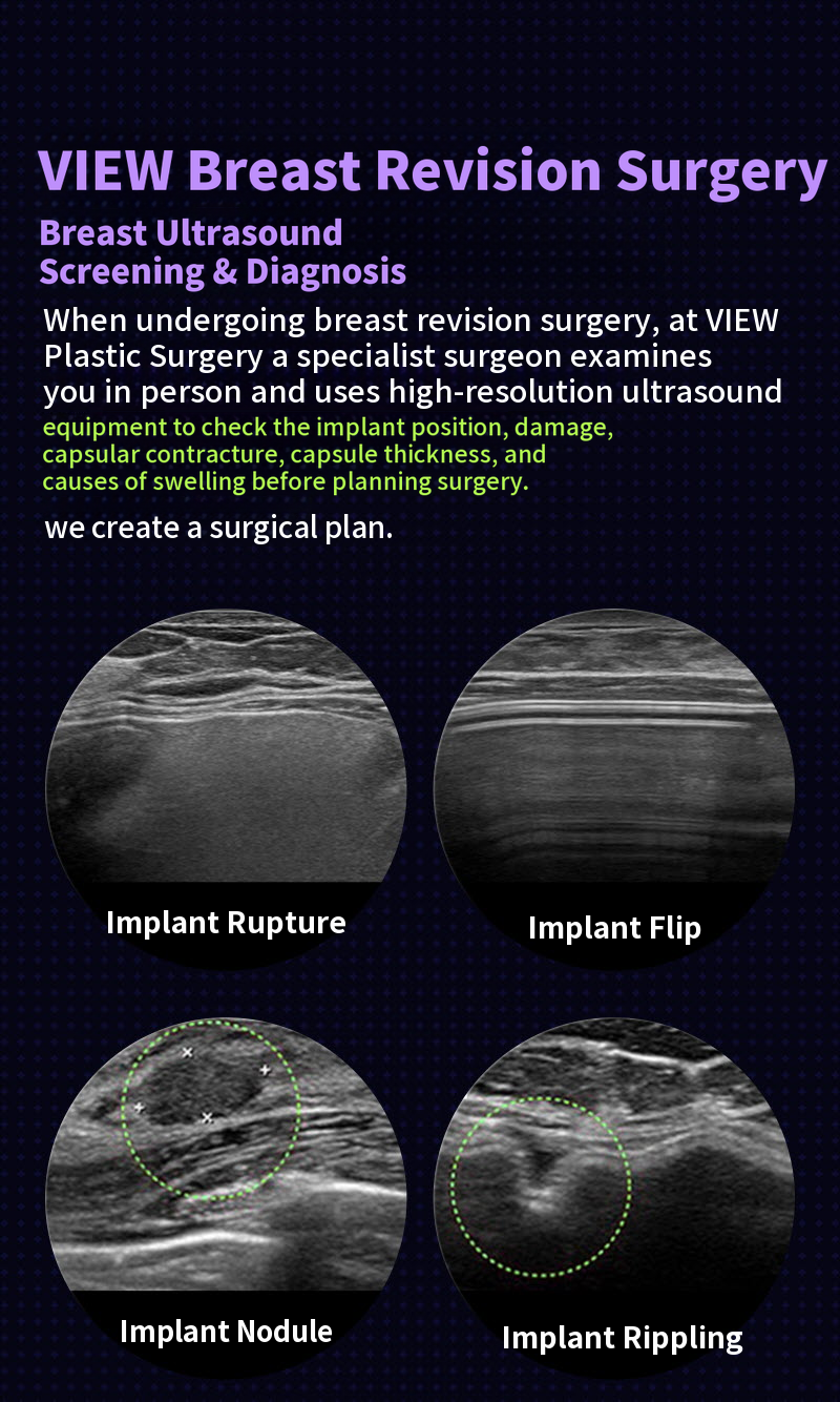 ❤View❤Motiva Breast Revision Surgery