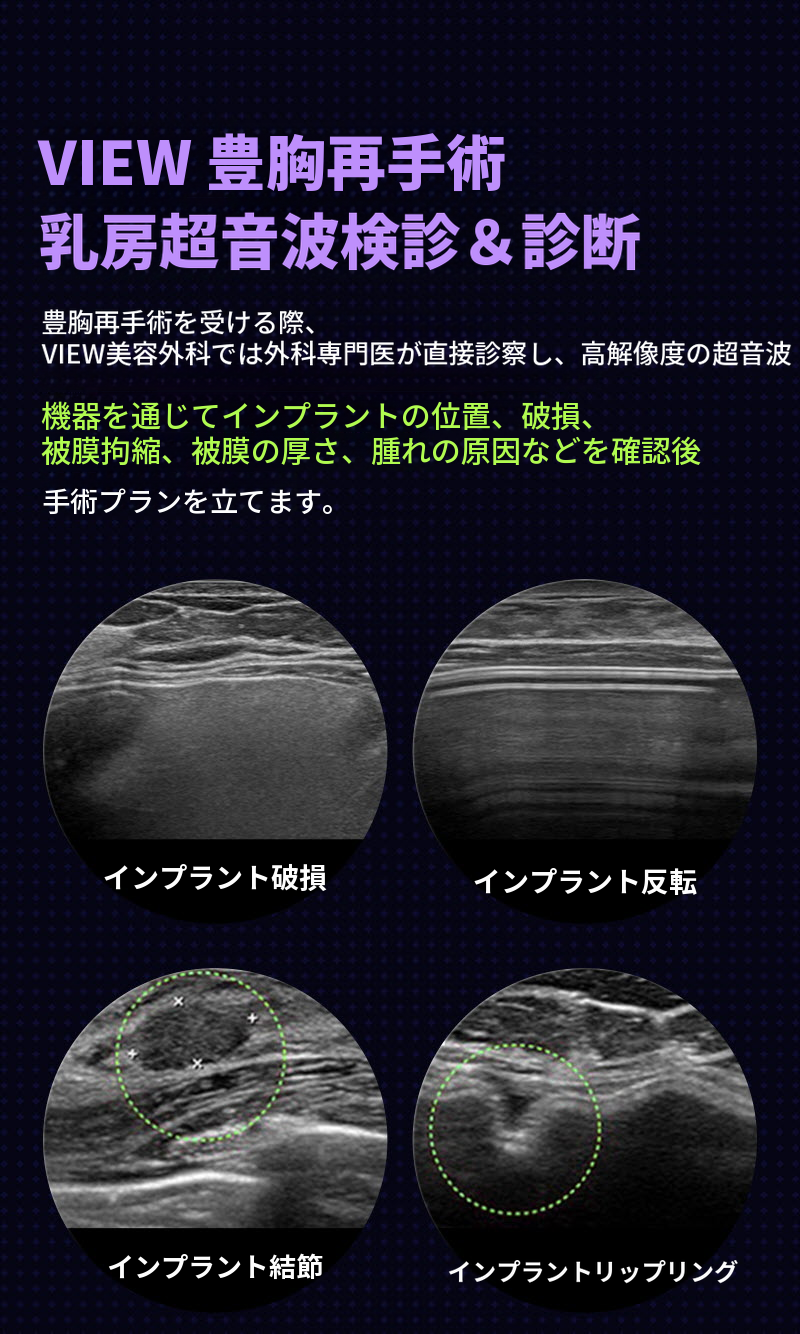 ❤ビュー❤モティバ 胸再手術