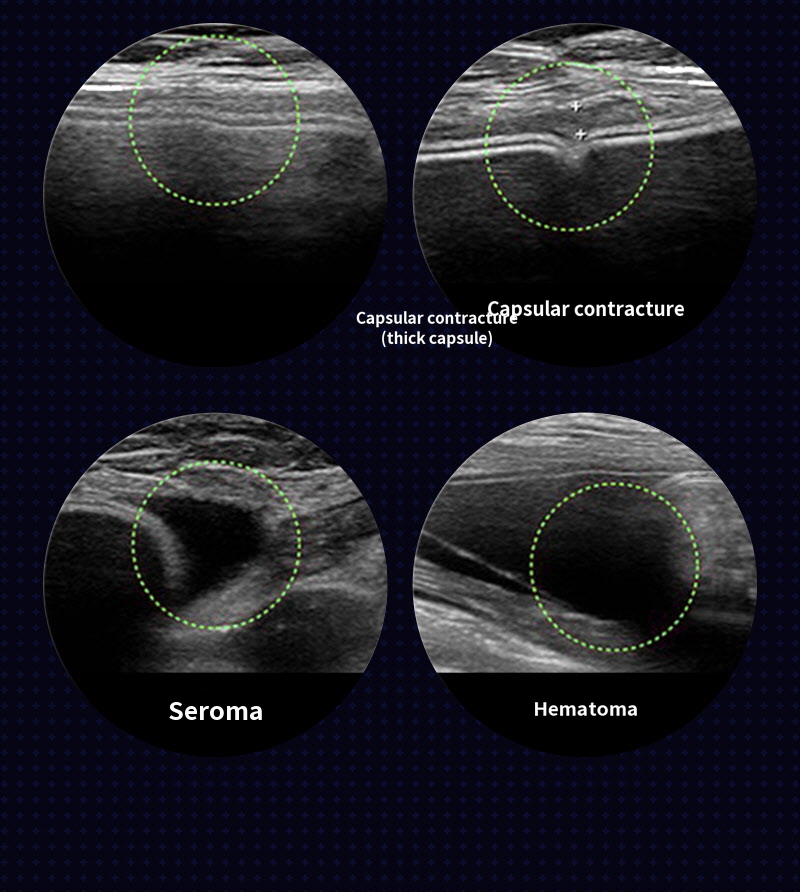 ❤View❤Motiva Breast Revision Surgery